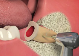 Oral Surgery