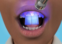 Porcelain Veneers