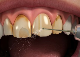 Porcelain Veneers