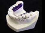 Inman Aligner Retraction Appliance